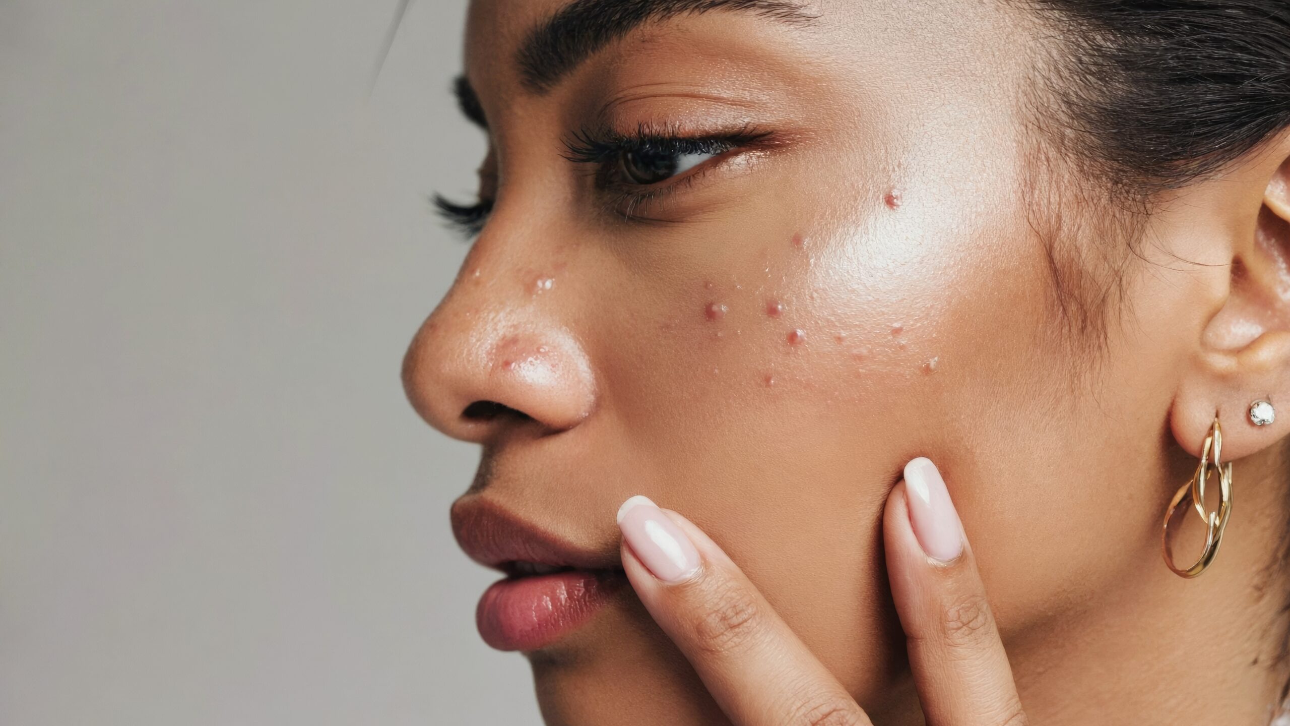 Professional acne treatment consultation with Nashville dermatologist